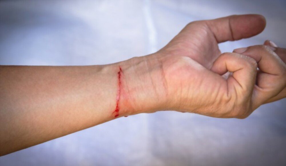 hand-full-blood-wrist-cut